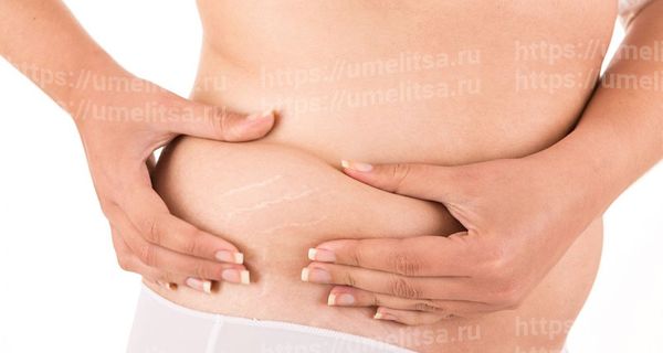 как избавиться от растяжек